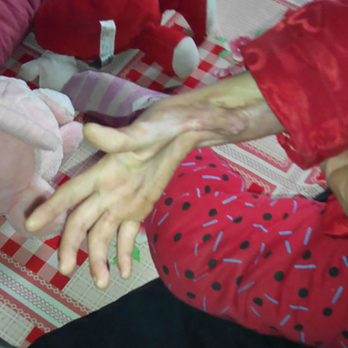 妤心植皮后，出現(xiàn)了非常嚴(yán)重的疤痕增生現(xiàn)象